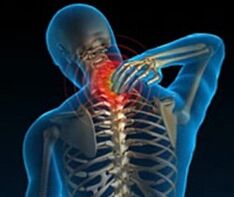 a nyaki gerinc osteochondrosisa