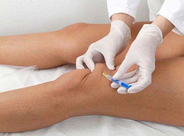 intraartikuláris injekció térd arthrosis esetén