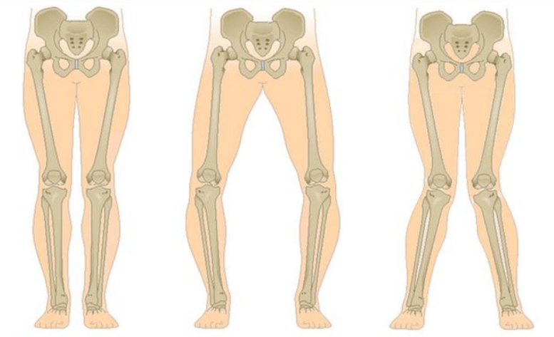 térd arthrosis szövődményei